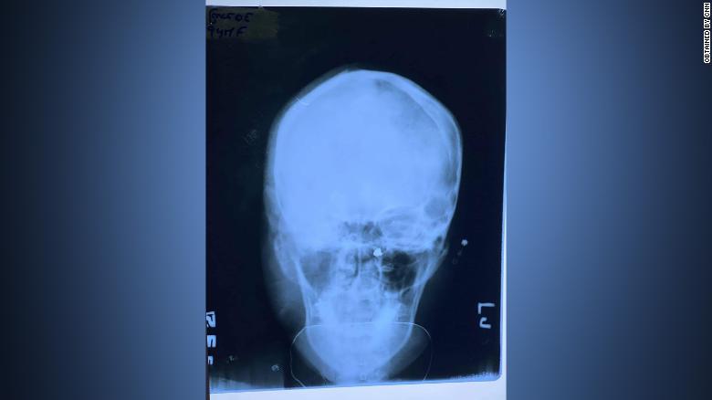 An x-ray of Ma Kyal Sin&#39;s skull after she was killed. The primary cause of death was brain injury caused by gunshot wound, said the doctor, who didn&#39;t want to be named for security reasons.