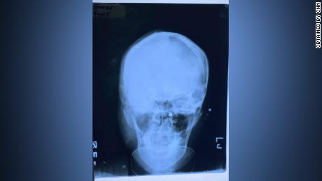 An x-ray of Ma Kyal Sin&#39;s skull after she was killed. The primary cause of death was brain injury caused by gunshot wound, said the doctor, who didn&#39;t want to be named for security reasons.