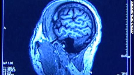 Accidente cerebrovascular y COVID-19