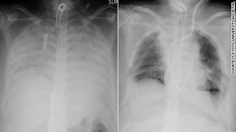 X-ray images show the patient&#39;s chest before the transplant operation, left, and after, right. The dark areas indicate where lung tissue has been transplanted. 