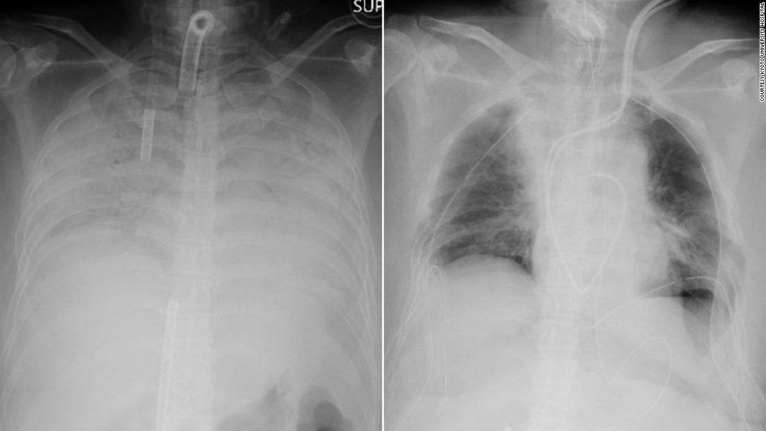 Japonijos gydytojai atlieka pirmąją pasaulyje gyvojo donoro plaučių transplantaciją COVID-19 pacientui