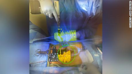 Using an AR headset called &quot;xvision,&quot; surgeons at Johns Hopkins Medicine can see layered digital images in real time during procedures.