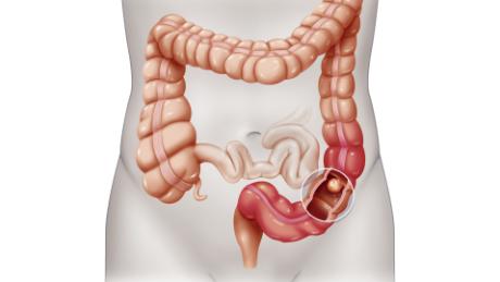 A colonoscopy study has some wondering if they should have the procedure. What you should know