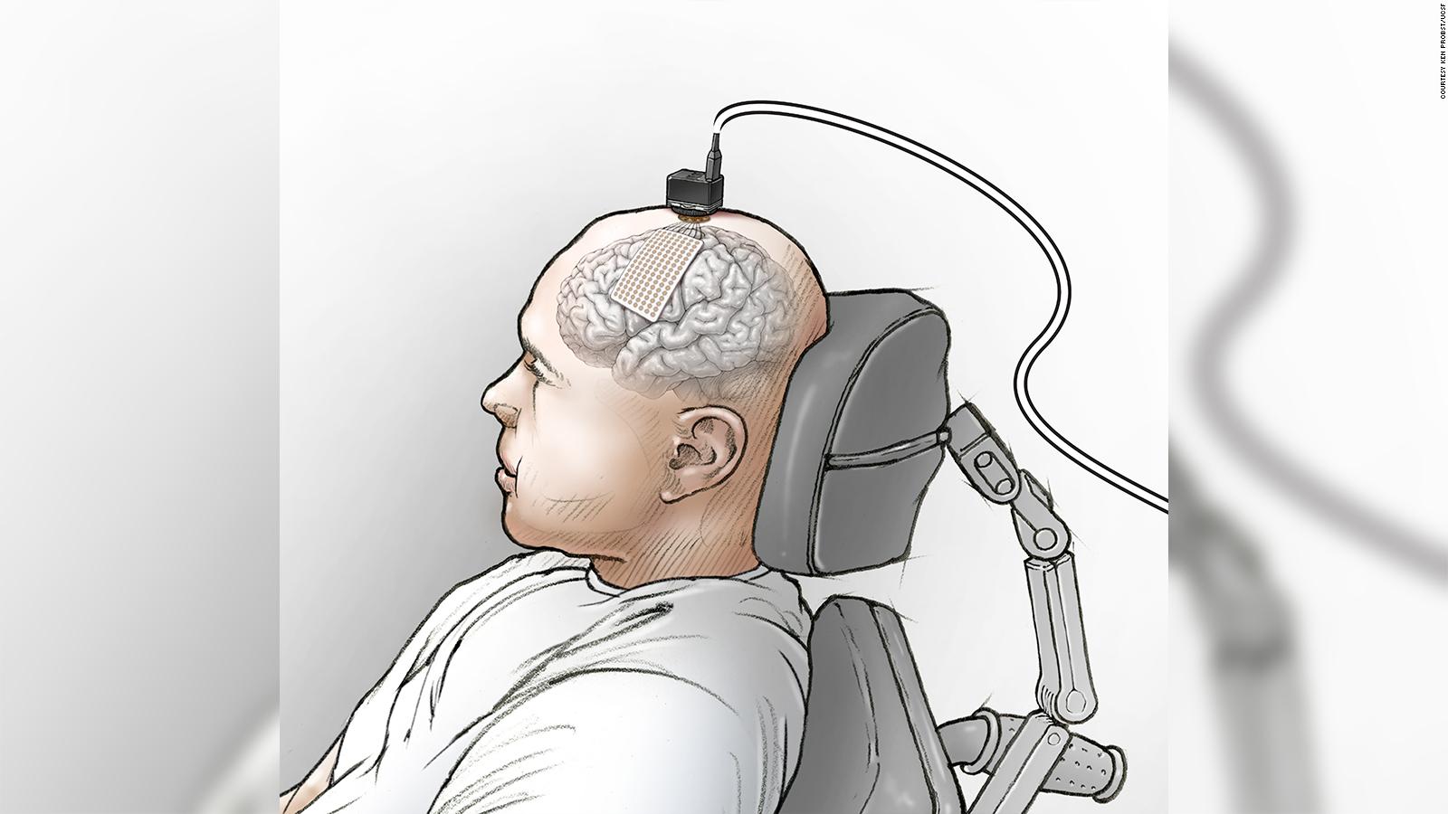 Neuroprosthesis Brain Implant Helps Man Speak Through A Computer Cnn