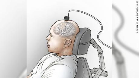 Illustration showing placement of the eCOG electrode on the participant&#39;s speech motor cortex and the head stages used to connect the electrode to the computer.