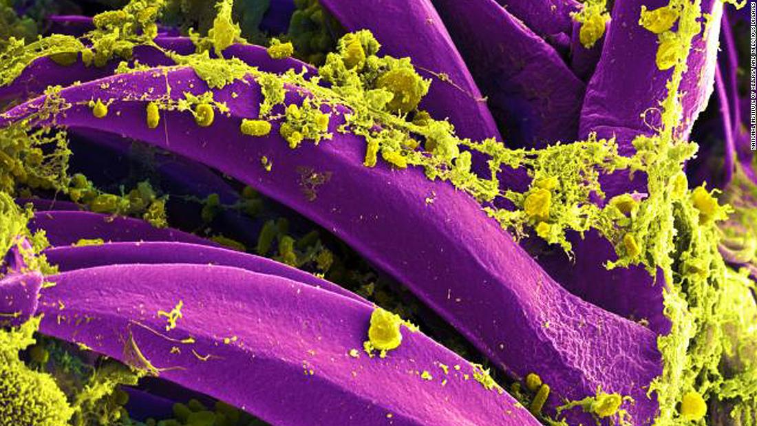 Colorado 10-year-old dies as health officials investigate plague activity