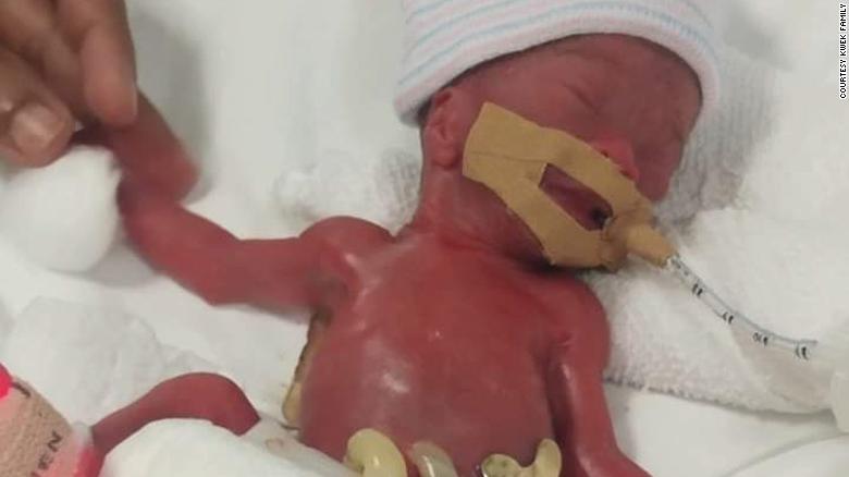 World’s smallest known baby at birth, who weighed 7.5 ounces, finally leaves hospital