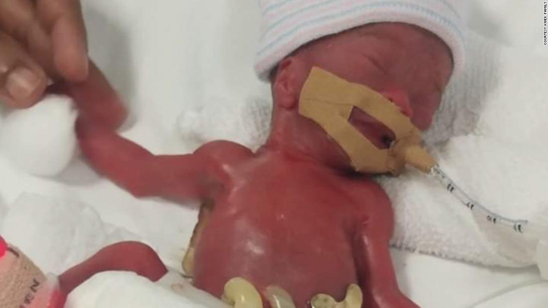 World's smallest known baby at birth, who weighed 7.5 ounces, finally leaves hospital