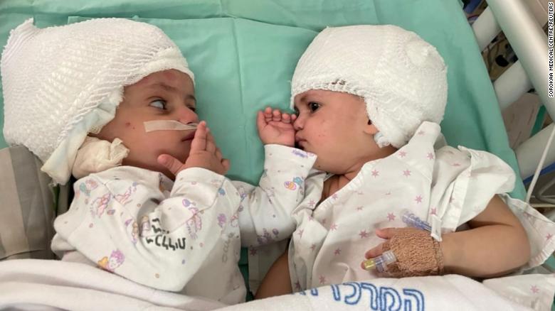 Twins joined at the head are separated after 12-hour surgery in Israel