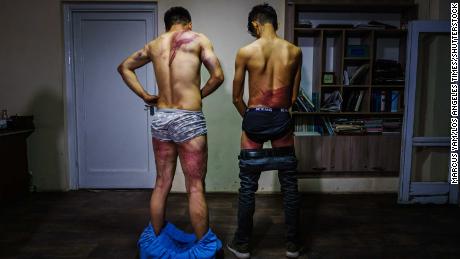 Nemat Naqdi (left) and Taqi Daryabi undress to show wounds sustained after Taliban fighters beat them while in custody on Wednesday. 