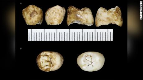 This image shows Leti&#39;s unemerged permanent premolar teeth.