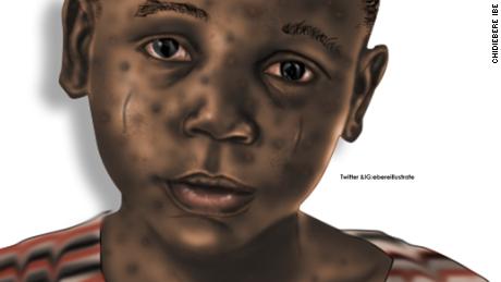 The vast majority of pictures in anatomy textbooks are of white people.  Ebe is working on a textbook on birth defects in children, which he says will be illustrated with pictures of black skin.
