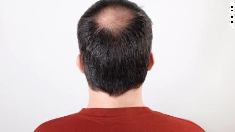 Male pattern baldness is one of the most common types of hair loss.