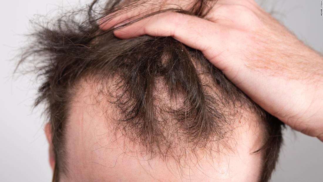 One Male Hair Loss Treatment Works Better Than Others Study Finds CNN   220201173956 01 Male Pattern Baldness Stock Super 169 