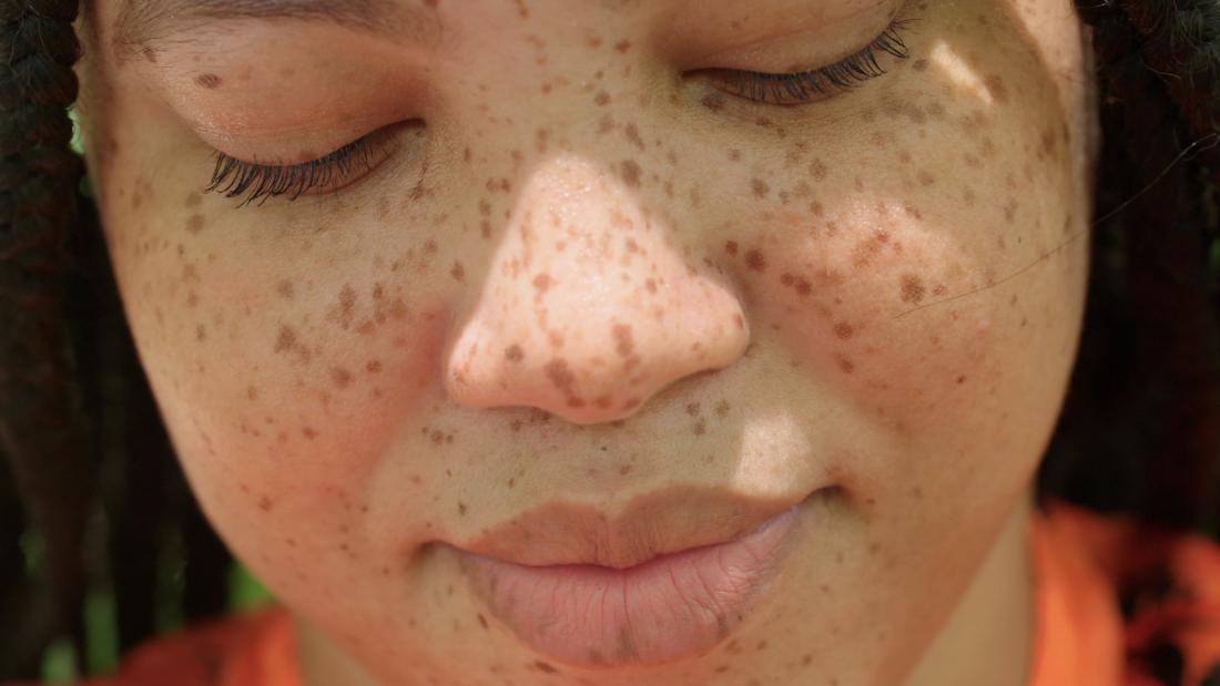 Freckles: The science, history and significance of these tiny marks of pigmentation – CNN Video