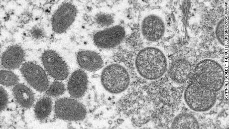 CDC and Massachusetts health officials investigating monkeypox case 