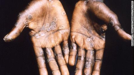 De handpalmen van een apenpokkenpatiënt in de Democratische Republiek Congo werden gezien tijdens een gezondheidsonderzoek in 1997.