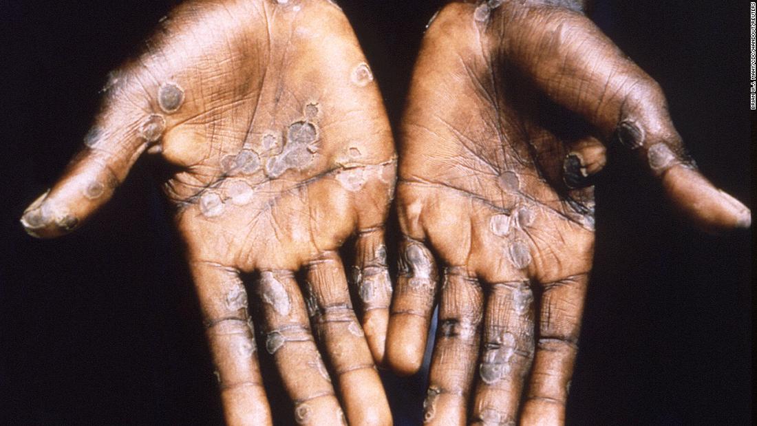 What is monkeypox and its signs and symptoms? – CNN