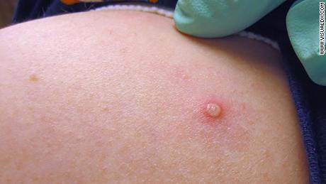 Monkeypox crée des varioles remplies de liquide qui sont contagieuses jusqu'à ce que les croûtes tombent, disent les experts.