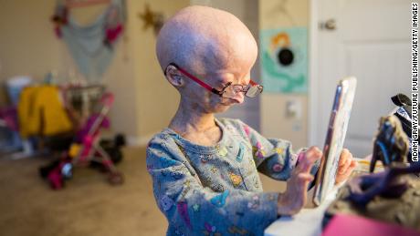 An 11-year-old Adalia plays with her phone in her bedroom in 2017. In addition to premature aging, other symptoms of progeria include dwarfism, lack of body fat and muscle, hair loss, visible veins, a high-pitched voice, and stiffness in the joints. 