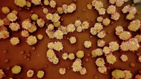 CNN goes inside clinic treating monkeypox as it grows