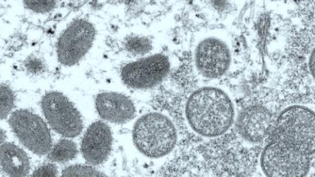 Monkeypox case reported in man whose &#39;primary risk factor&#39; was close, nonsexual contact at a crowded outdoor event