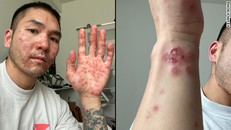 Kevin Kwong își arată leziunile de variola de maimuță.  El s-a vindecat recent de variola maimuțelor după ce a fost diagnosticat la începutul lunii iulie.