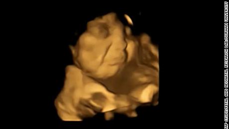 A 4D scan image of the same fetus showing a crying facial response after exposure to the taste of black.