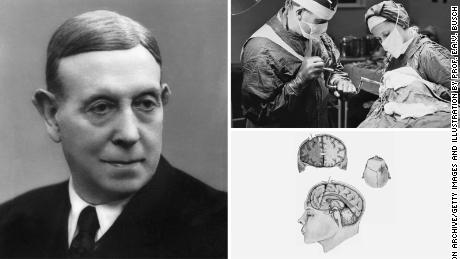 Left: Portuguese neurologist Antonio Egas Moniz was awarded the Nobel Prize in 1949 for pioneering the prefrontal lobotomy.
Upper right: Lobotomies became a popular treatment option from the 1930s to the early 1950s. Here, a surgeon drills into a patient&#39;s skull at a hospital in England, 1946.
Lower right: By cutting tracts through brain matter in the frontal lobe, the belief was the lobotomy could treat symptoms of mental illness.