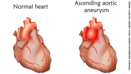 An aortic aneurysm is a bulge in the aorta, the large artery that carries blood from the heart through the chest and torso, according to the US Centers for Disease Control and Prevention.

