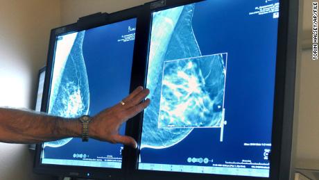 Only 14% of diagnosed cancers in the US are detected by screening, report says