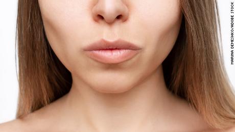 Why everyone is suddenly talking about buccal fat removal