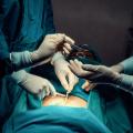 La liposucción es ahora la cirugía estética más popular, superando al  aumento de senos - CNN Video