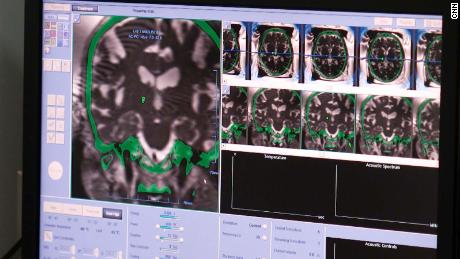 Pictured are scans of Hric&#39;s brain. Focused ultrasound signficantly improved the 80-year-old&#39;s tremors.