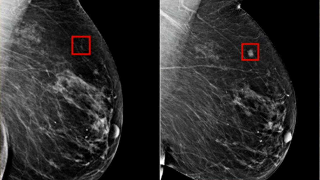 Images show AI detecting breast cancer 4 years before it developed