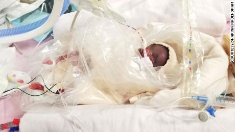 Adrial was born weighing less than 15 ounces.
