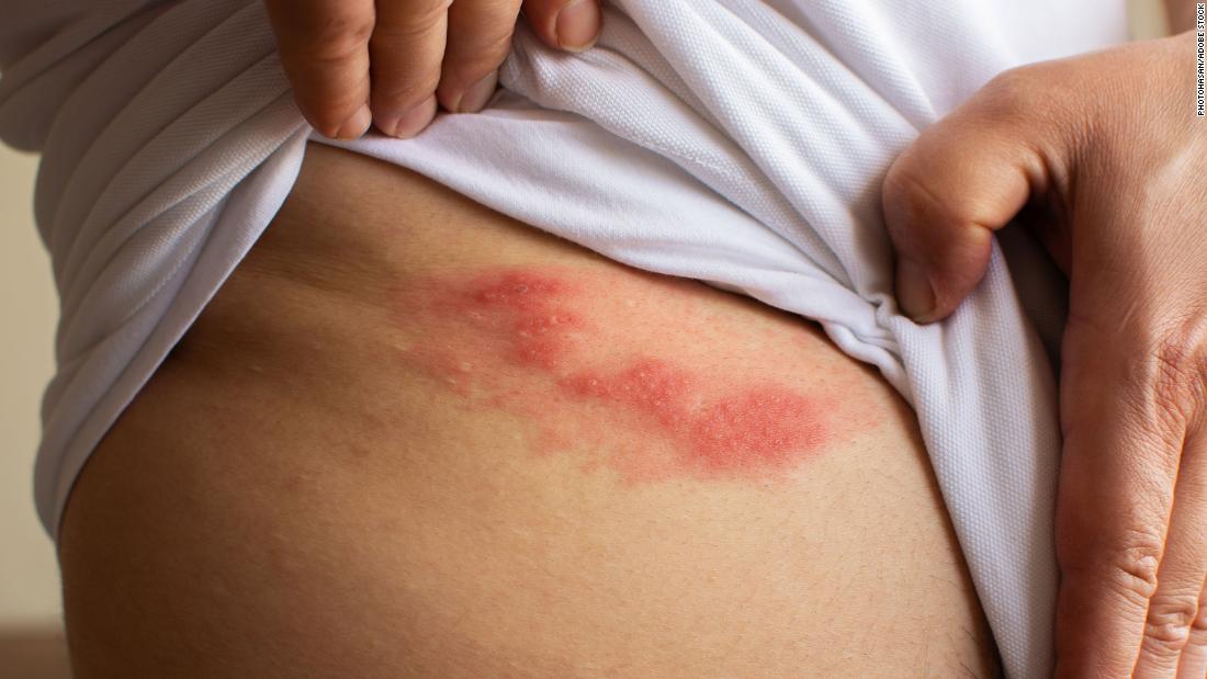 What is the painful condition called shingles?