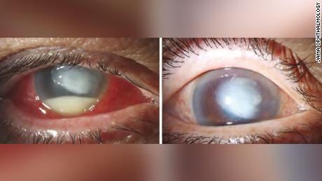 In another case, a 72-year-old man had a severe infection in his eye, left. Although it had improved a month later, right, he still experienced vision problems.