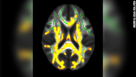 This figure shows increased neuroinflammation (yellow colors) with higher hidden fat (visceral fat) in our larger cohort of 54 persons with an average age of 50 years in the brain's white matter. The green colors are the normal white matter. There is increased neuroinflammation with a higher amount of visceral fat. 